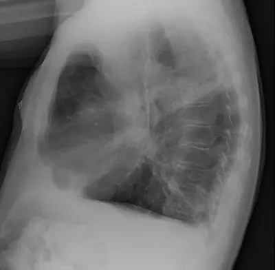 Radiograph from the case bank: Emphysema / COPD (hyperinflation)