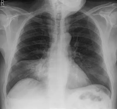 Radiograph from the case bank: Pneumonia (consolidation)