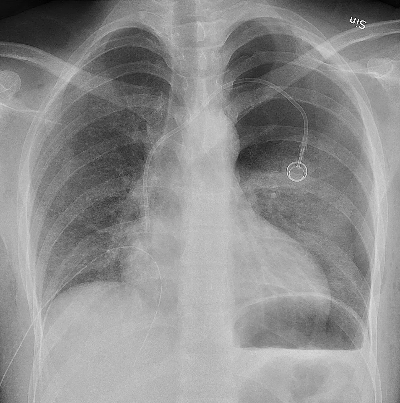 Chest radiograph for self-assessment