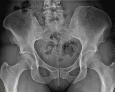 Radiograph from the case bank: Calcified uterine fibroid