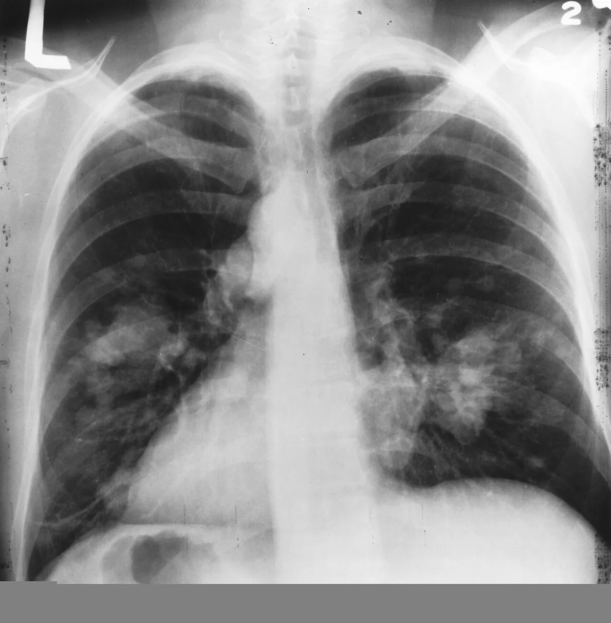 Chest radiograph for self-assessment