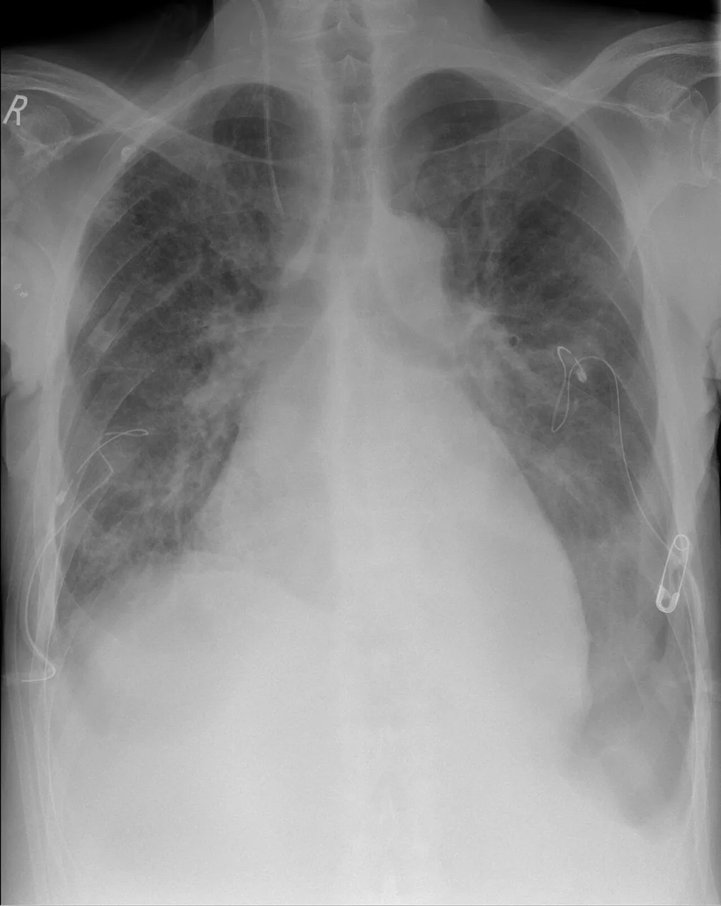 Chest radiograph for self-assessment
