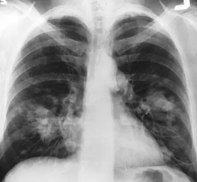 Radiograph from the case bank: Lung cancer (mass)