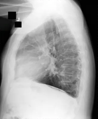 Radiograph from the case bank: Asbestos-related pleural disease