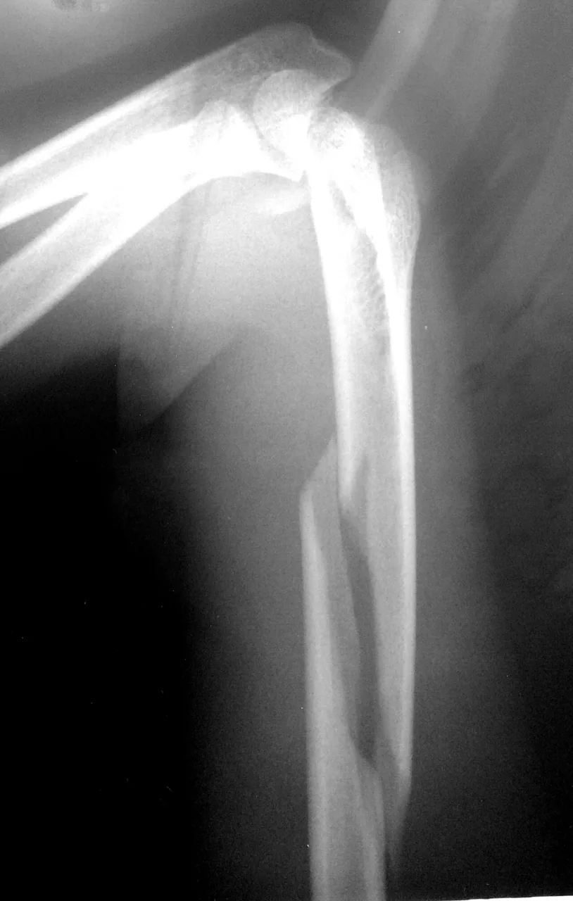 Upper limb radiograph for self-assessment
