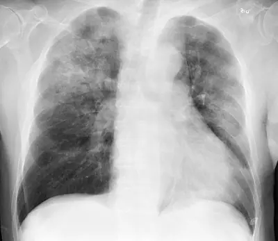 Radiograph from the case bank: Pneumonia (consolidation)