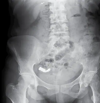 Radiograph from the case bank: Foreign body (ingested or inserted)