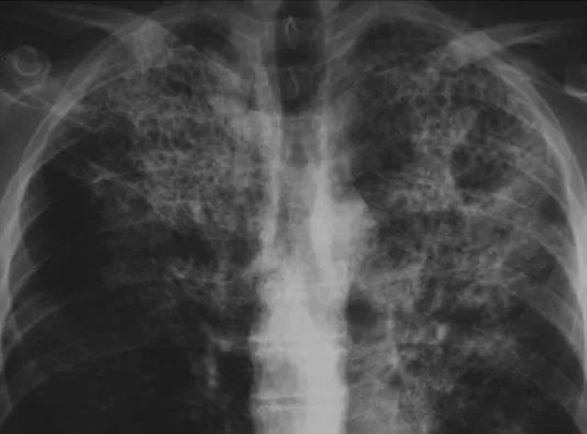 Chest radiograph for self-assessment