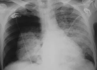 Radiograph from the case bank: Pneumocystis pneumonia (PCP)