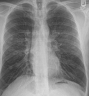 Radiograph from the case bank: Sarcoidosis