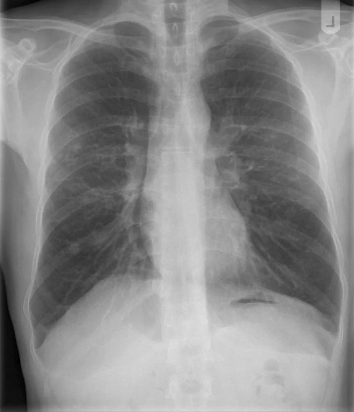 Chest radiograph for self-assessment