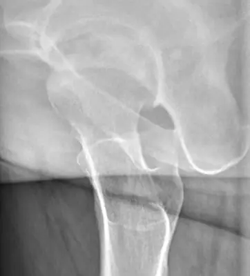 Radiograph from the case bank: Avascular necrosis of the femoral head