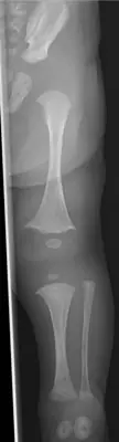 Radiograph from the case bank: Osteogenesis imperfecta