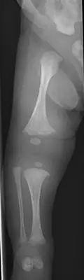 Radiograph from the case bank: Osteogenesis imperfecta