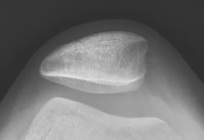 Radiograph from the case bank: Knee joint effusion