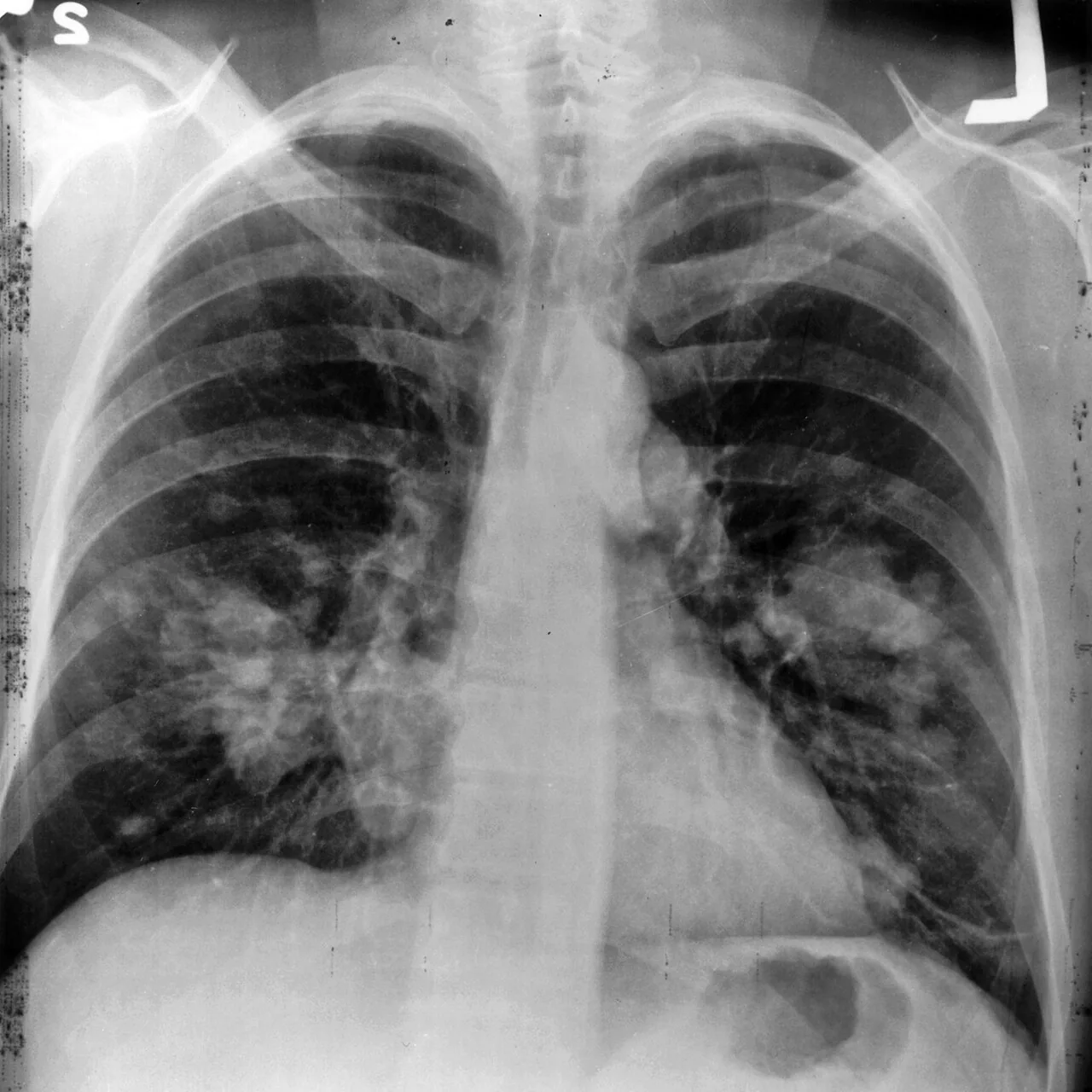 Chest radiograph for self-assessment