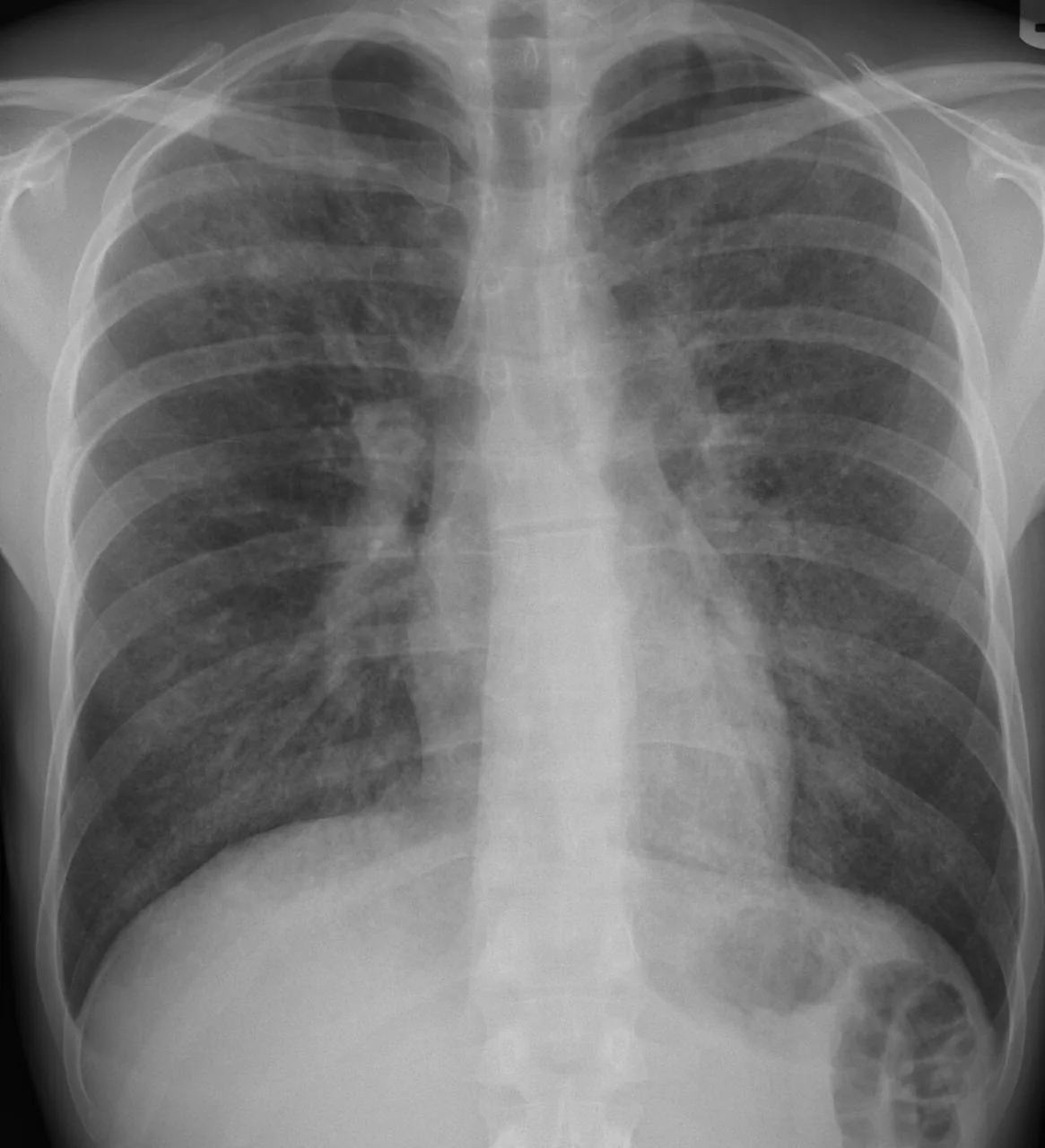 Chest radiograph for self-assessment