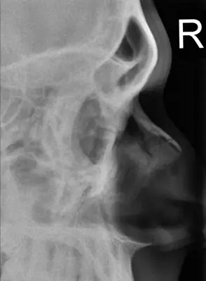 Radiograph from the case bank: Nasal bone fracture