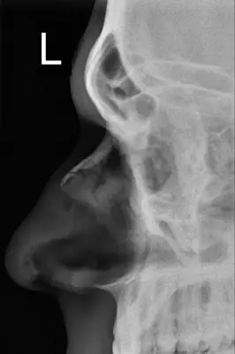 Radiograph from the case bank: Nasal bone fracture