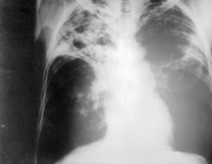Chest radiograph for self-assessment