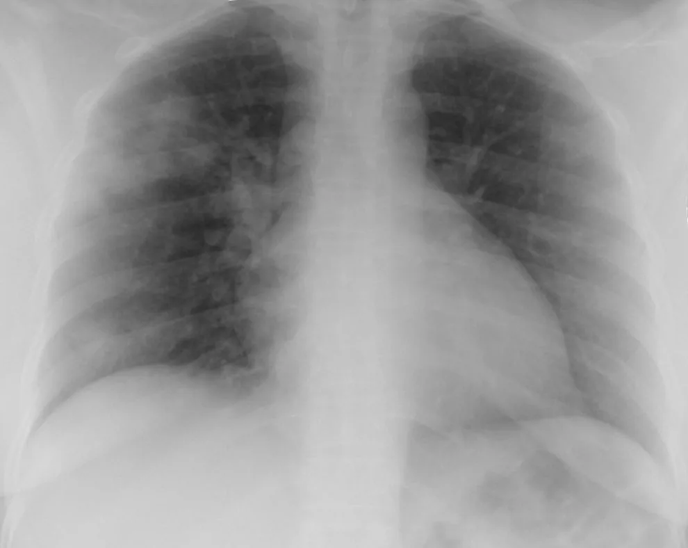 Chest radiograph for self-assessment