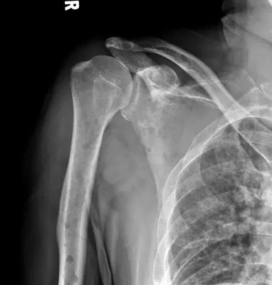 Radiograph from the case bank: Multiple myeloma