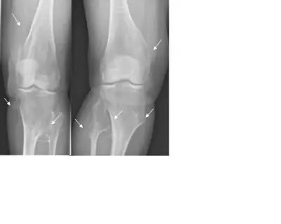 Radiograph from the case bank: Osteochondroma (exostosis)