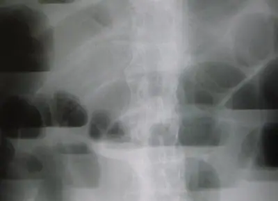 Radiograph from the case bank: Bowel obstruction