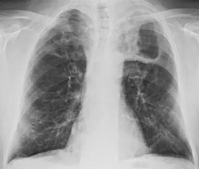 Radiograph from the case bank: Pulmonary tuberculosis