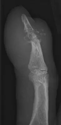 Radiograph from the case bank: Gout