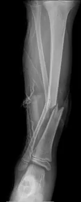 Radiograph from the case bank: Tibial (and fibular) shaft fracture