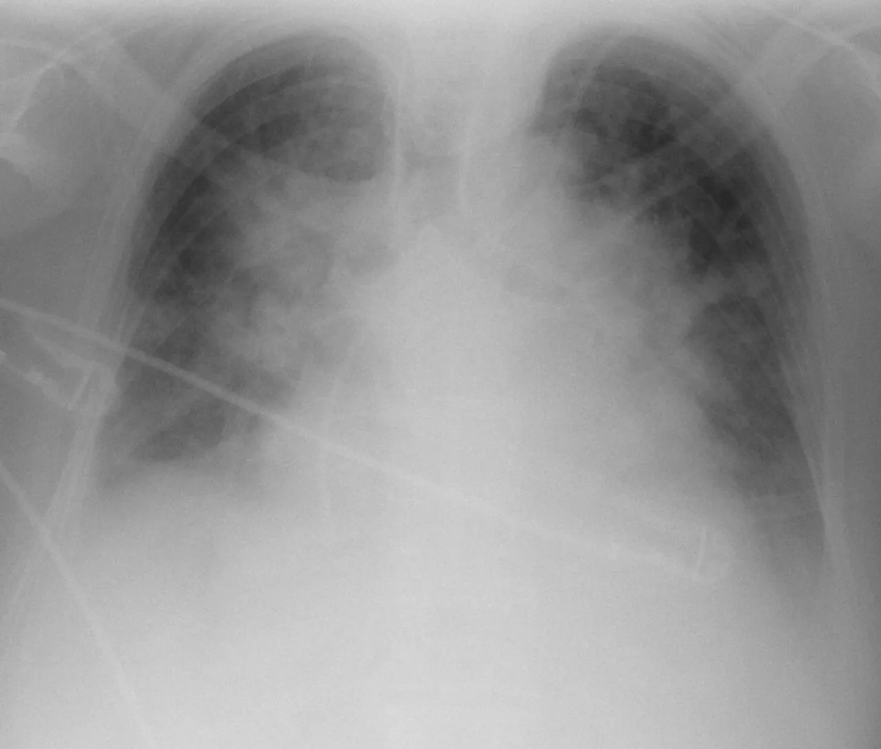 Chest radiograph for self-assessment