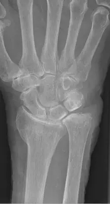 Radiograph from the case bank: Distal radius fracture