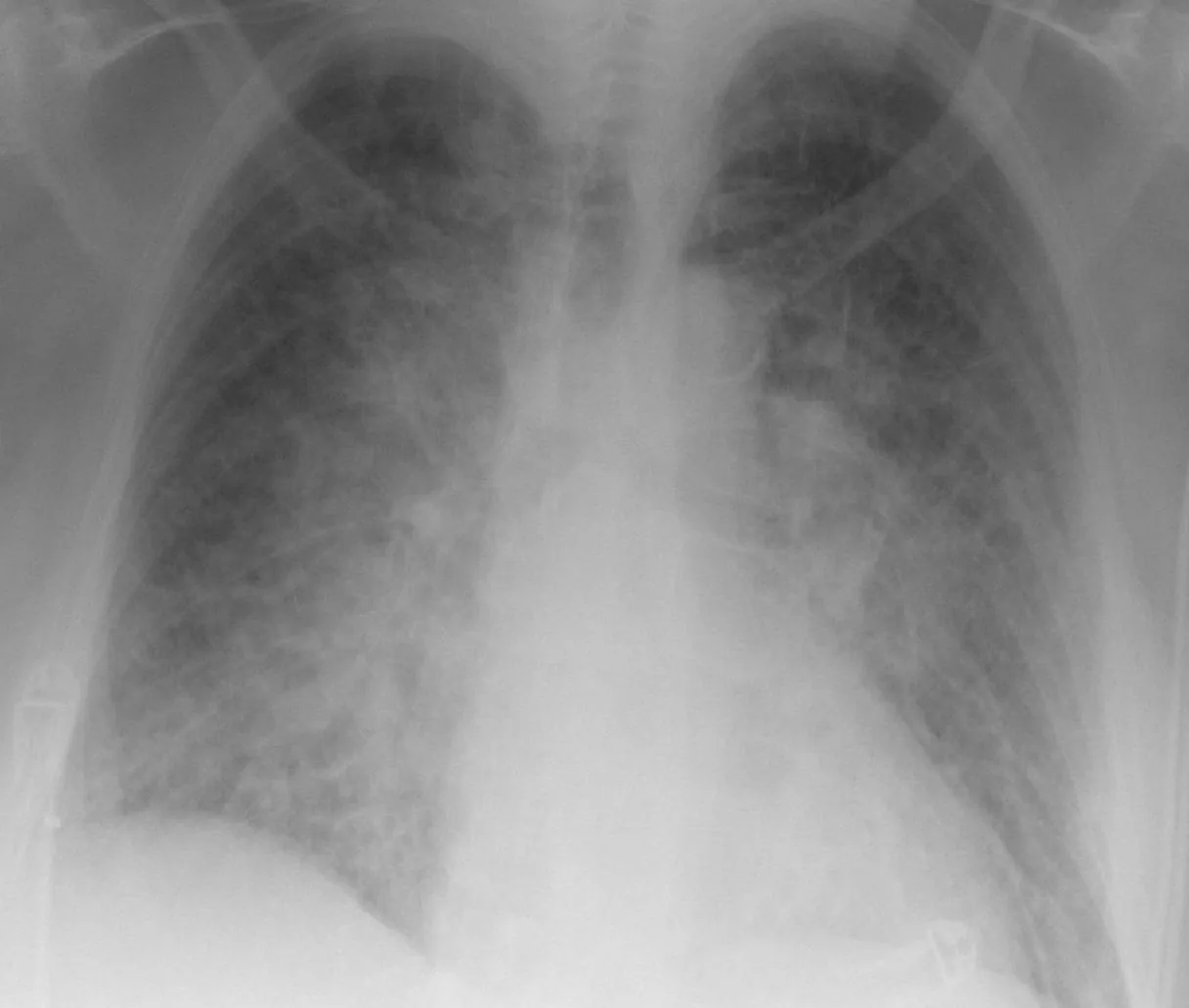 Chest radiograph for self-assessment