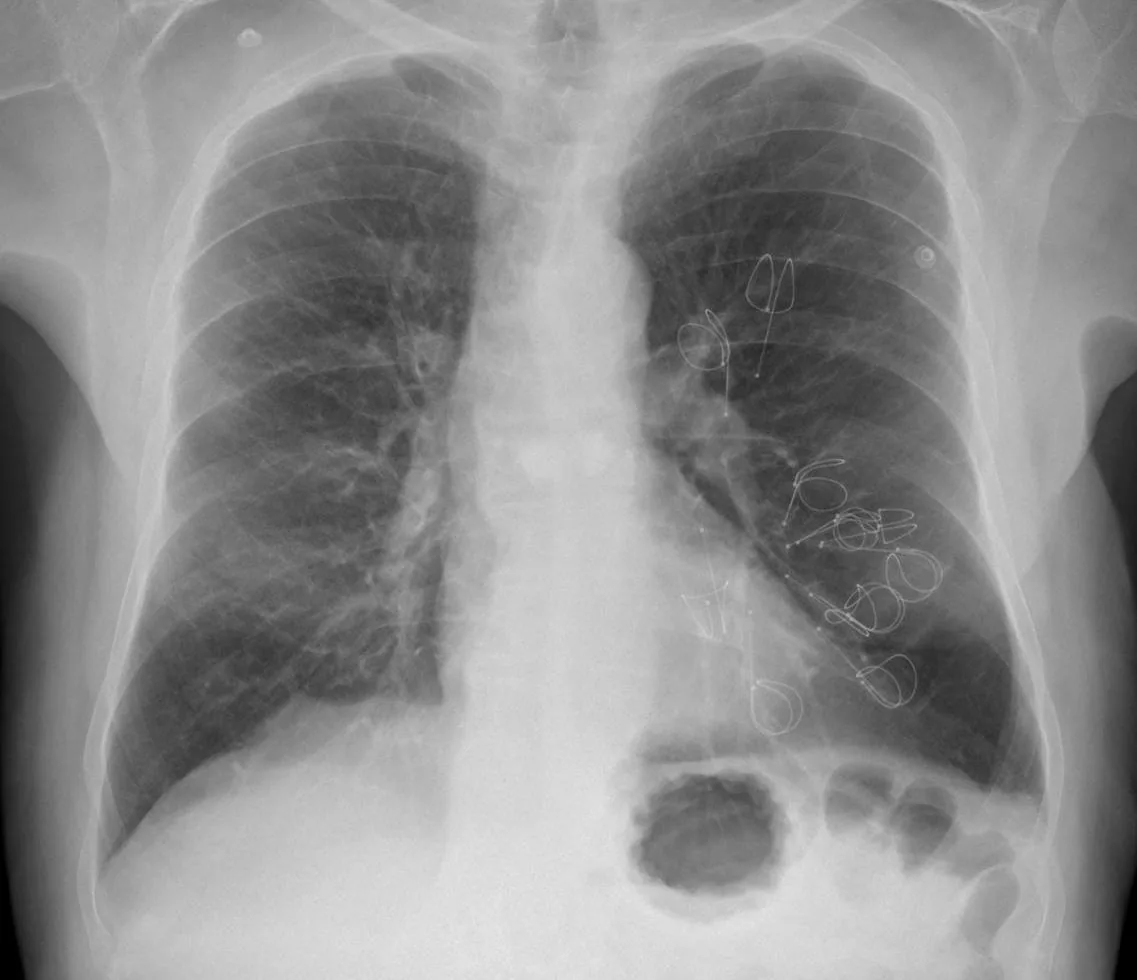 Chest radiograph for self-assessment