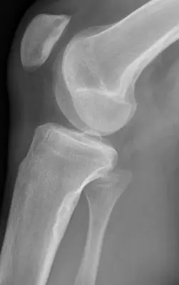 Radiograph from the case bank: Non-ossifying fibroma