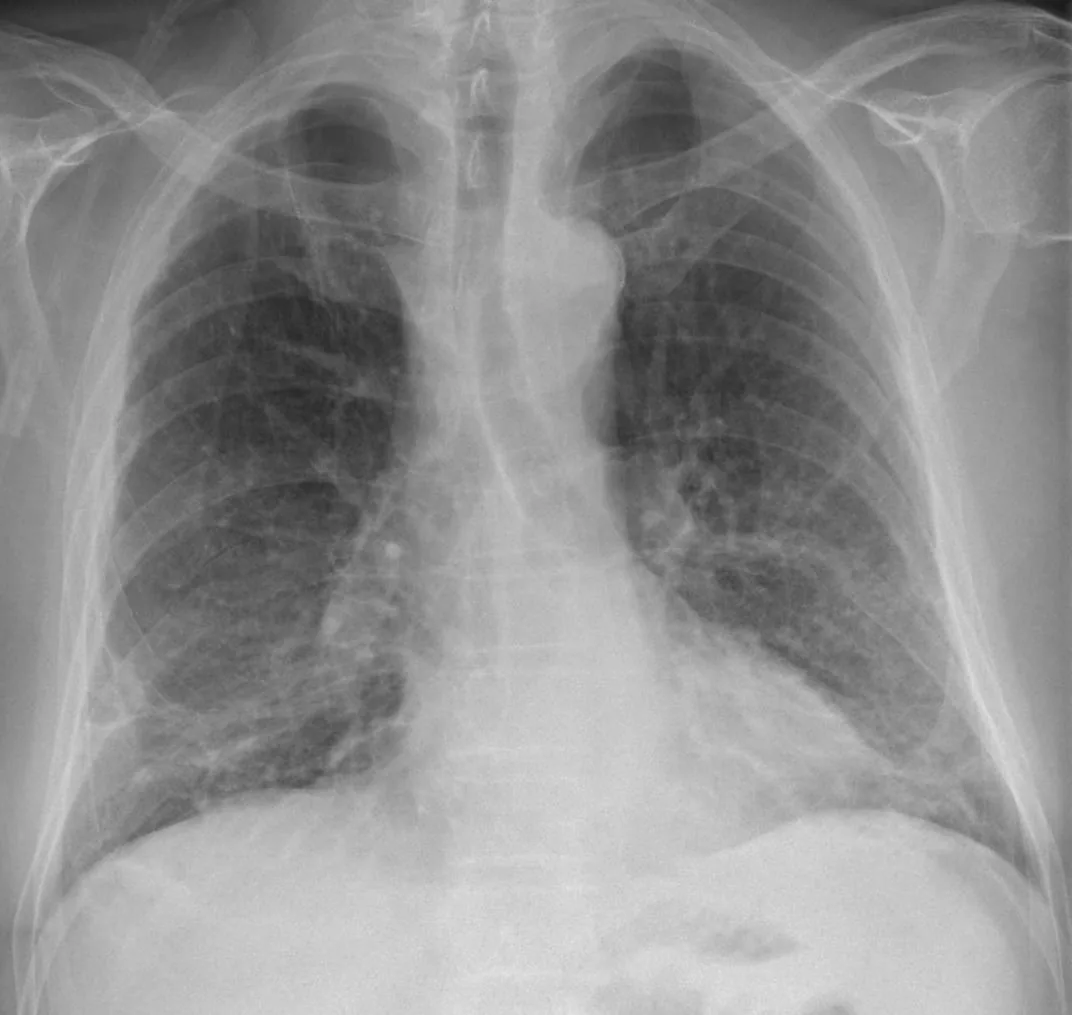 Chest radiograph for self-assessment