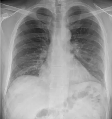 Radiograph from the case bank: COVID-19 pneumonia