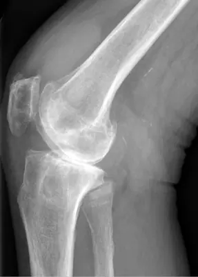 Radiograph from the case bank: Knee joint effusion