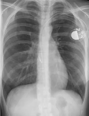 Radiograph from the case bank: Cardiac pacemaker
