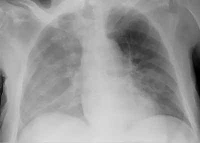 Radiograph from the case bank: Pleural effusion