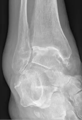 Radiograph from the case bank: Osteoarthritis