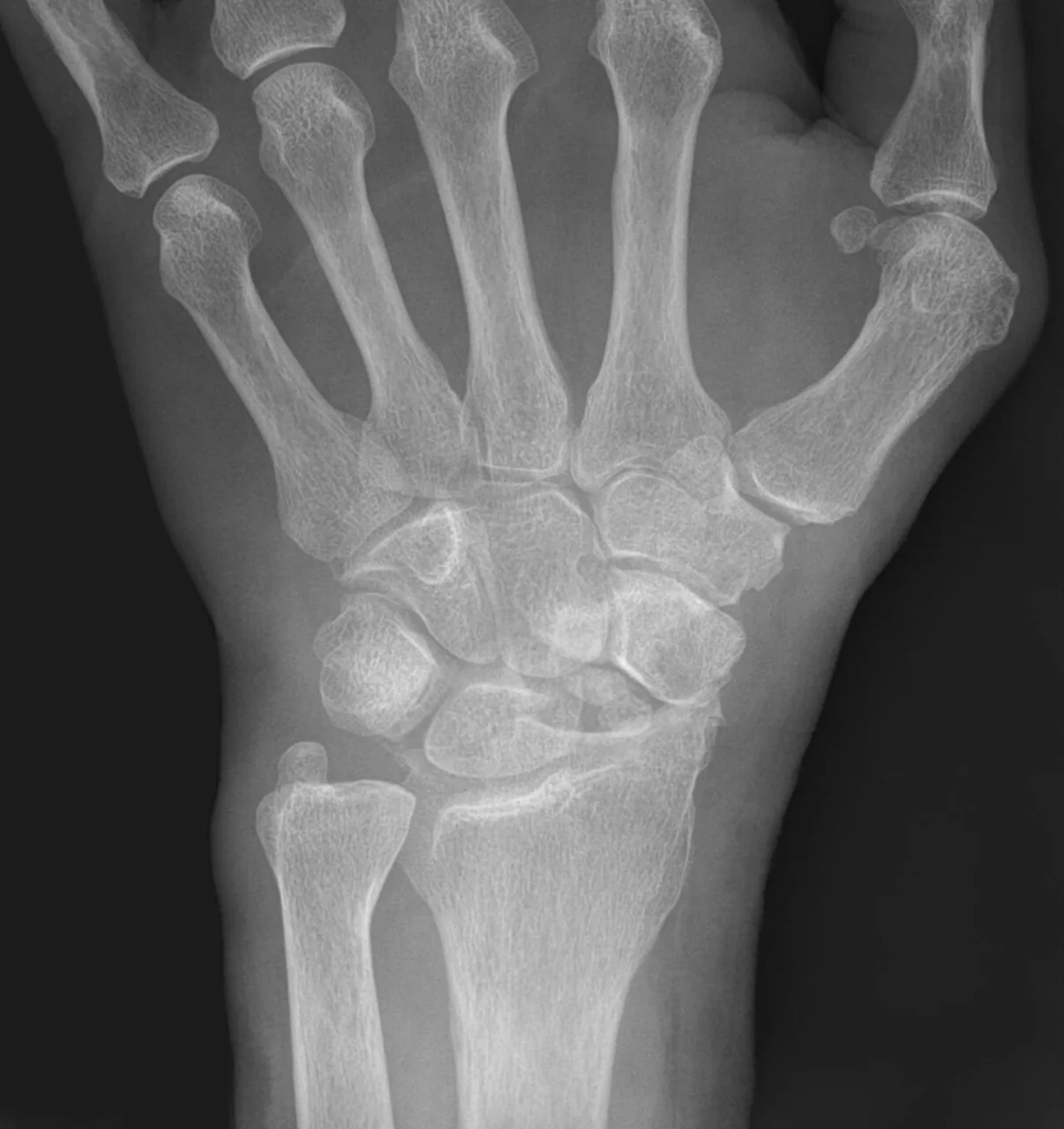 Upper limb radiograph for self-assessment