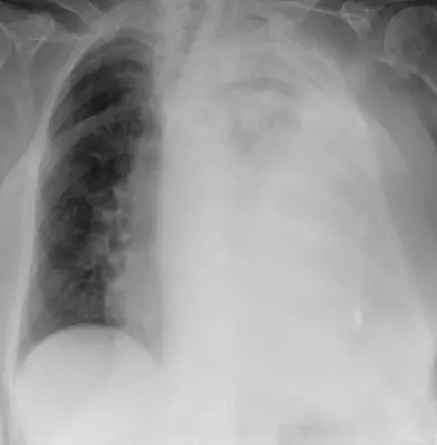 Radiograph from the case bank: Pleural effusion