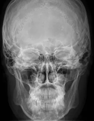 Radiograph from the case bank: Maxillary sinusitis