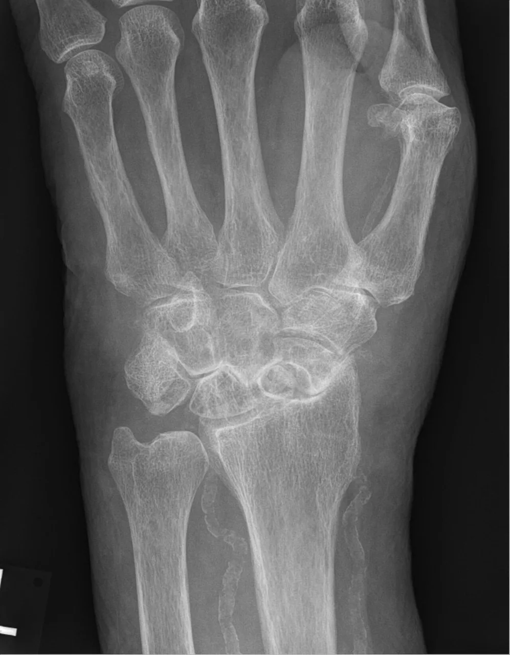 Upper limb radiograph for self-assessment