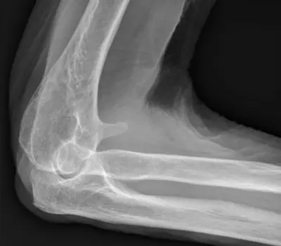Radiograph from the case bank: Osteochondroma (exostosis)