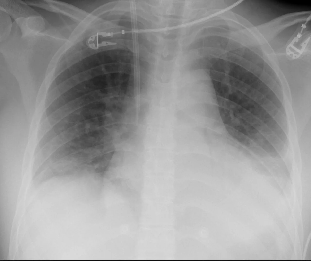 Lines & tubes radiograph for self-assessment