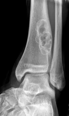 Radiograph from the case bank: Non-ossifying fibroma