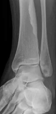 Radiograph from the case bank: Non-ossifying fibroma